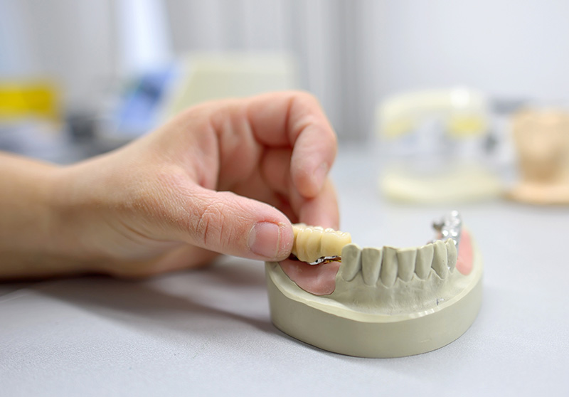 Dental Bridges in Sundance
