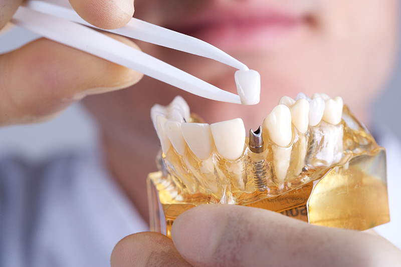 Dental Implants in Sundance